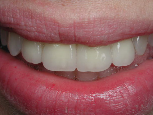 veneers