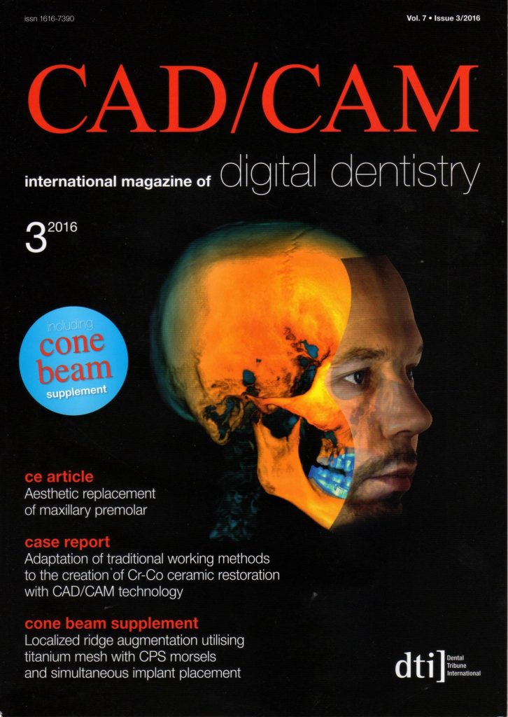 Adaptation of traditional working methods to the creation of Cr/Co ceramic restoration with CAD-CAM technology
