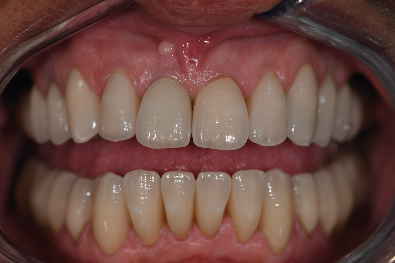 After image