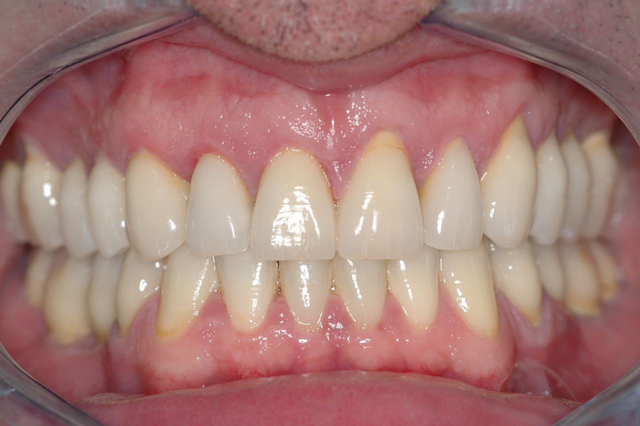 After image