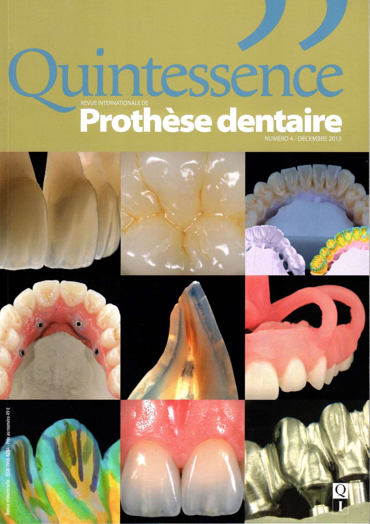 Custom abutments and selective microfusion reinforcement