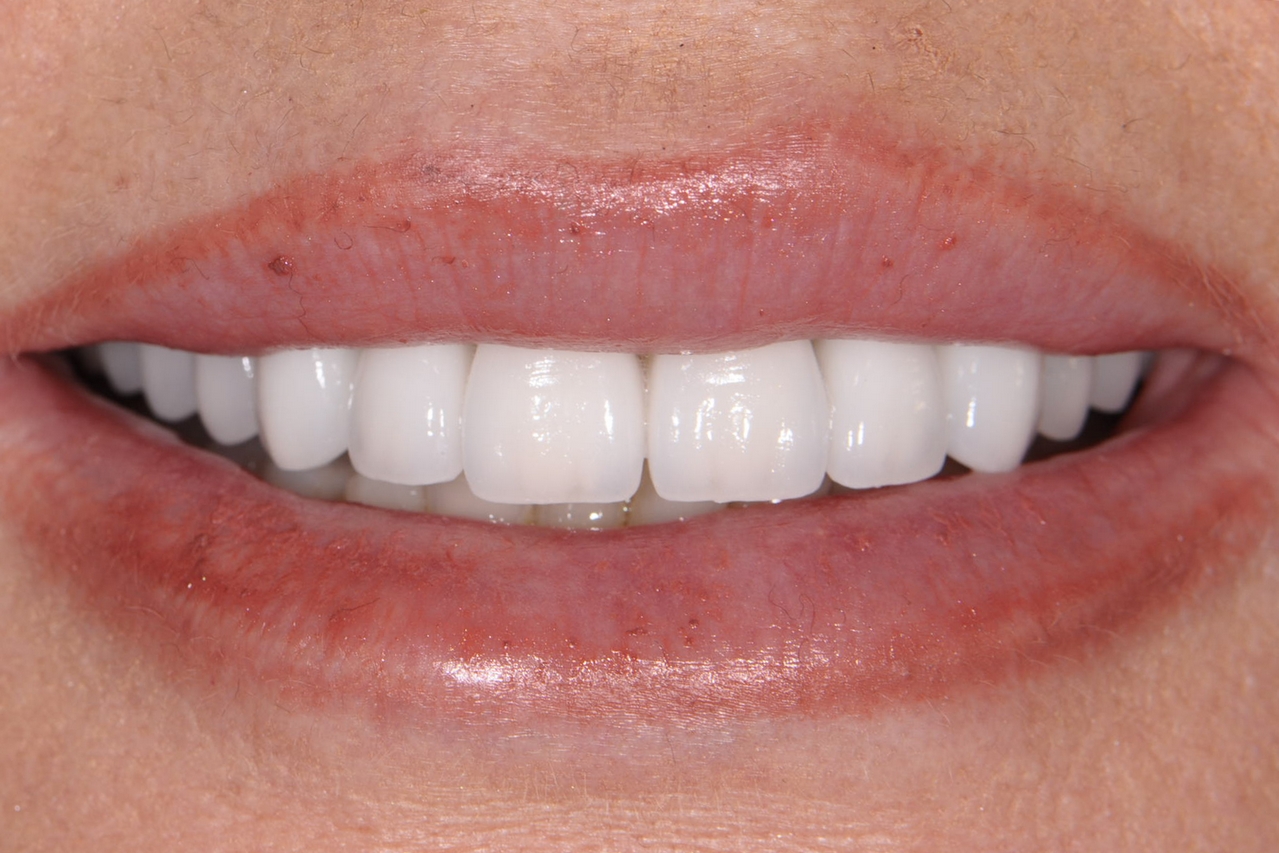 After image