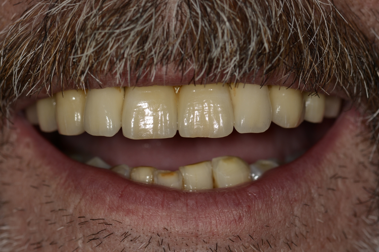 After image