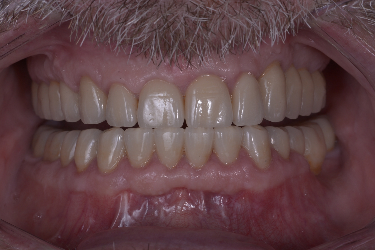 After image